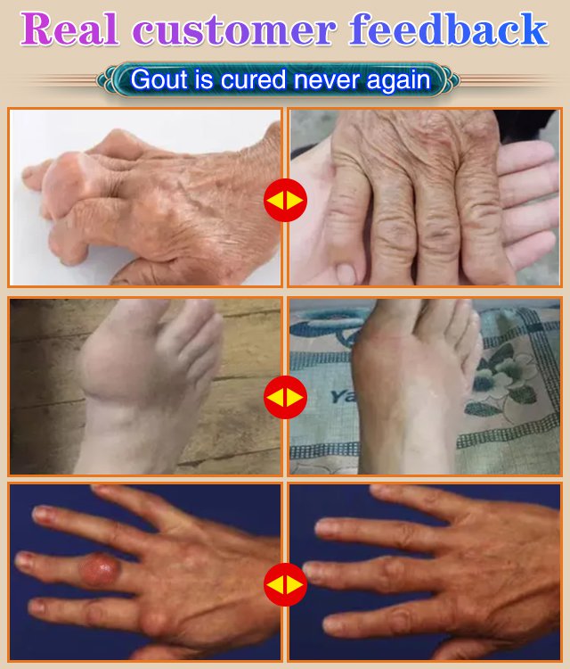 Gout Treatment Cream